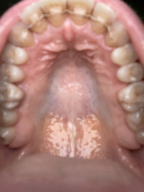 The image shows an interior view of a mouth looking up at the roof of the mouth with the entire row of teeth.